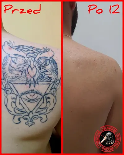 Laserowe Usuwanie Tatuażu Radom